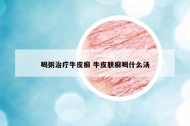 喝粥治疗牛皮癣 牛皮肤癣喝什么汤