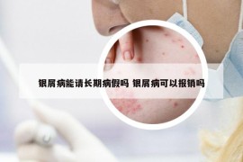 银屑病能请长期病假吗 银屑病可以报销吗