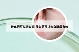 什么药可以治白斑 什么药可以治白斑最有效