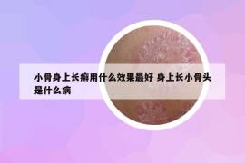 小骨身上长癣用什么效果最好 身上长小骨头是什么病