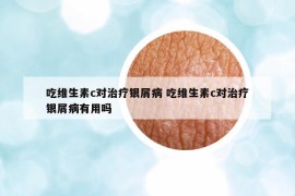 吃维生素c对治疗银屑病 吃维生素c对治疗银屑病有用吗