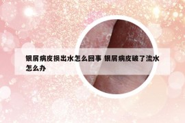 银屑病皮损出水怎么回事 银屑病皮破了流水怎么办