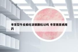 寻常型牛皮癣吃消银颗粒以吗 寻常银屑病用药