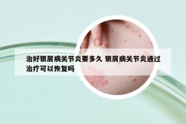 治好银屑病关节炎要多久 银屑病关节炎通过治疗可以恢复吗