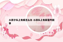 小孩子头上有癣怎么办 小孩头上有藓是咋回事