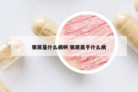 银屑是什么病啊 银屑属于什么病