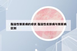 脂溢性银屑病的症状 脂溢性皮肤病与银屑病区别