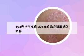 308光疗牛皮癣 308光疗治疗银屑病怎么样