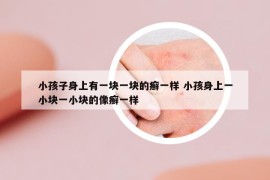 小孩子身上有一块一块的癣一样 小孩身上一小块一小块的像癣一样