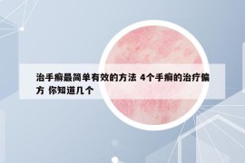 治手癣最简单有效的方法 4个手癣的治疗偏方 你知道几个