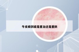 牛皮癣到底是重治还是重防