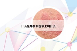 什么是牛皮癣医学上叫什么