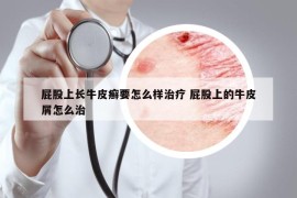 屁股上长牛皮癣要怎么样治疗 屁股上的牛皮屑怎么治