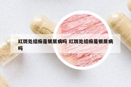 红斑处结痂是银屑病吗 红斑处结痂是银屑病吗