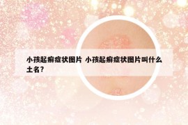 小孩起癣症状图片 小孩起癣症状图片叫什么土名?