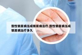 假性银屑病当成银屑病治疗 假性银屑病当成银屑病治疗多久