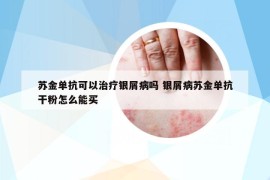 苏金单抗可以治疗银屑病吗 银屑病苏金单抗干粉怎么能买