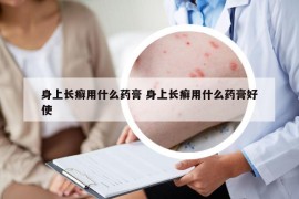 身上长癣用什么药膏 身上长癣用什么药膏好使