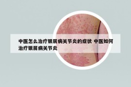 中医怎么治疗银屑病关节炎的症状 中医如何治疗银屑病关节炎