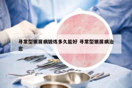 寻常型银屑病锻炼多久能好 寻常型银屑病治愈