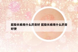 屁股长癣用什么药膏好 屁股长癣用什么药膏好使