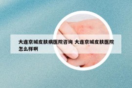 大连京城皮肤病医院咨询 大连京城皮肤医院怎么样啊