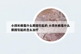 小孩长癣是什么原因引起的 小孩长癣是什么原因引起的怎么治疗