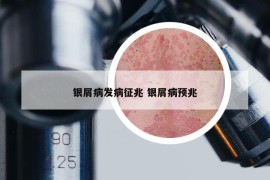 银屑病发病征兆 银屑病预兆