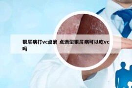 银屑病打vc点滴 点滴型银屑病可以吃vc吗