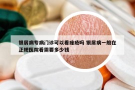 银屑病专病门诊可以看痤疮吗 银屑病一般在正规医院看需要多少钱