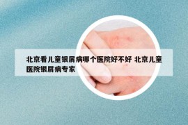 北京看儿童银屑病哪个医院好不好 北京儿童医院银屑病专家