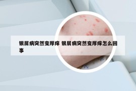 银屑病突然变厚痒 银屑病突然变厚痒怎么回事