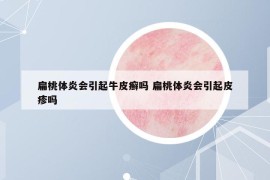 扁桃体炎会引起牛皮癣吗 扁桃体炎会引起皮疹吗