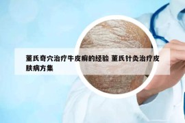 董氏奇穴治疗牛皮癣的经验 董氏针灸治疗皮肤病方集