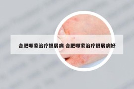 合肥哪家治疗银屑病 合肥哪家治疗银屑病好