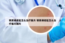 银屑病老起怎么治疗偏方 银屑病老起怎么治疗偏方图片