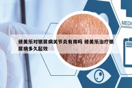 修美乐对银屑病关节炎有用吗 修美乐治疗银屑病多久起效