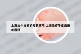 上海治牛皮癣的专职医院 上海治疗牛皮病癣的医院