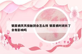 银屑病天天接触到会怎么样 银屑病时间长了会有影响吗