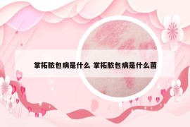 掌拓脓包病是什么 掌拓脓包病是什么菌