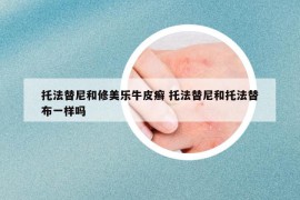 托法替尼和修美乐牛皮癣 托法替尼和托法替布一样吗