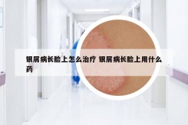 银屑病长脸上怎么治疗 银屑病长脸上用什么药