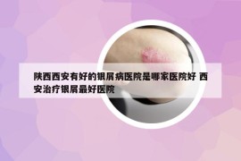 陕西西安有好的银屑病医院是哪家医院好 西安治疗银屑最好医院