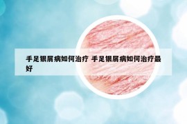 手足银屑病如何治疗 手足银屑病如何治疗最好