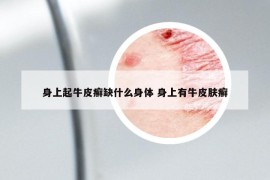 身上起牛皮癣缺什么身体 身上有牛皮肤癣