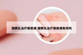 健脾丸治疗银屑病 健脾丸治疗银屑病有效吗