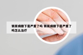 银屑病腋下是严重了吗 银屑病腋下是严重了吗怎么治疗