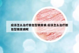 应该怎么治疗脓包型银屑病 应该怎么治疗脓包型银屑病呢