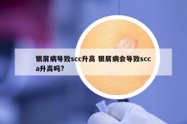 银屑病导致scc升高 银屑病会导致scca升高吗?