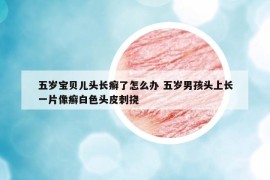 五岁宝贝儿头长癣了怎么办 五岁男孩头上长一片像癣白色头皮刺挠